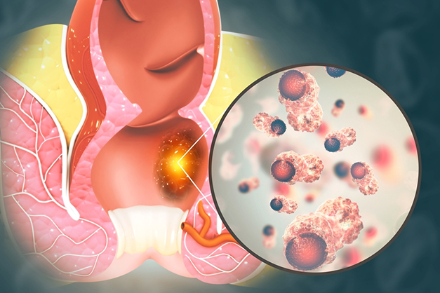                                               علاج الشرخ الشرجي
                                              
